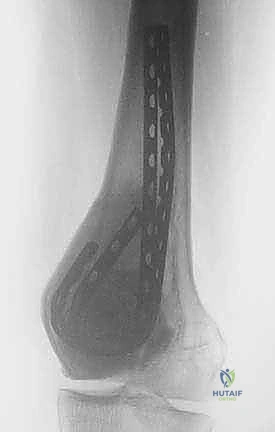 تحليل الأشعة السينية والرنين المغناطيسي لأورام العظام