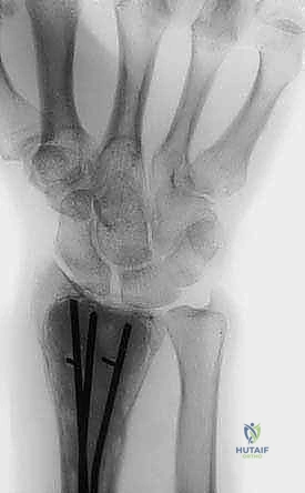 جلسات العلاج الطبيعي لاستعادة مدى حركة المفصل