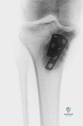 صورة توضيحية لـ الاستئصال بالتبريد لأورام العظام: دليل شامل للمرضى مع الأستاذ الدكتور محمد هطيف