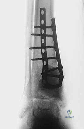 صورة طبية: الاستئصال بالتبريد لأورام العظام: دليل شامل للمرضى مع الأستاذ الدكتور محمد هطيف