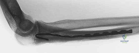 صورة توضيحية لـ الاستئصال بالتبريد لأورام العظام: دليل شامل للمرضى مع الأستاذ الدكتور محمد هطيف