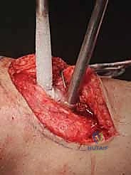 الدكتور محمد هطيف أثناء إجراء عملية دقيقة لاستئصال ورم عظمي