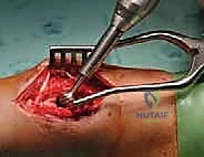 صورة توضيحية لـ الاستئصال بالتبريد لأورام العظام: دليل شامل للمرضى مع الأستاذ الدكتور محمد هطيف