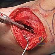 تجهيز أدوات الاستئصال بالتبريد في غرفة العمليات