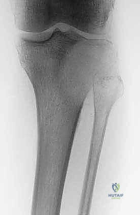 مقارنة نتائج العمليات الجراحية باستخدام أحدث التقنيات