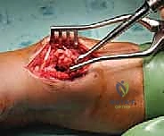 عزل وحماية الأعصاب والأوعية الدموية المحيطة بالعظم