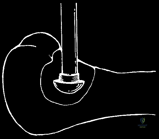 ملء التجويف العظمي بالإسمنت الطبي لتدعيم العظم