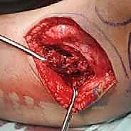 صورة طبية: الاستئصال بالتبريد لأورام العظام: دليل شامل للمرضى مع الأستاذ الدكتور محمد هطيف