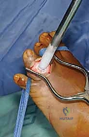 صورة طبية: الاستئصال بالتبريد لأورام العظام: دليل شامل للمرضى مع الأستاذ الدكتور محمد هطيف