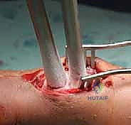 صورة توضيحية لـ الاستئصال بالتبريد لأورام العظام: دليل شامل للمرضى مع الأستاذ الدكتور محمد هطيف