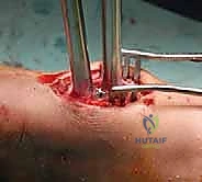 بدء العلاج الطبيعي والمشي باستخدام العكازات