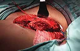 صورة توضيحية لـ الاستئصال بالتبريد لأورام العظام: دليل شامل للمرضى مع الأستاذ الدكتور محمد هطيف