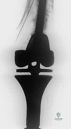 صورة توضيحية لـ الاستئصال بالتبريد لأورام العظام: دليل شامل للمرضى مع الأستاذ الدكتور محمد هطيف