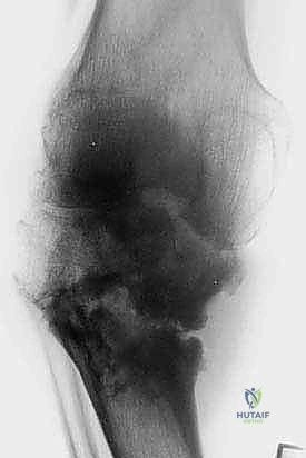 استخدام التقنيات الحديثة في جراحة العظام بصنعاء