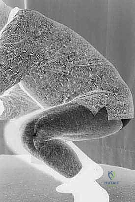 صورة توضيحية لـ الاستئصال بالتبريد لأورام العظام: دليل شامل للمرضى مع الأستاذ الدكتور محمد هطيف