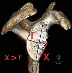 صورة توضيحية لـ ترميم التجويف الحقاني للكتف بترقيع عظمي ذاتي