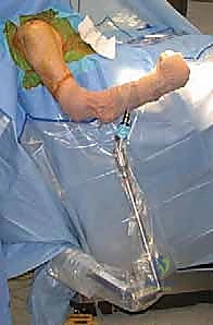 تقييم حجم العظم المفقود