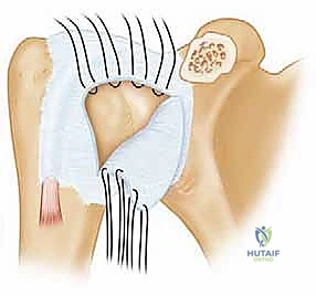 الوصول إلى مفصل الكتف الأمامي