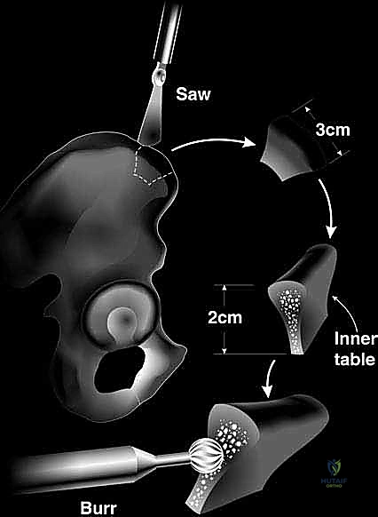 ترميم التجويف الحقاني للكتف بترقيع عظمي ذاتي: حل جذري لعدم استقرار الكتف المتكرر في صنعاء