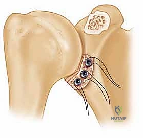 صورة توضيحية لـ ترميم التجويف الحقاني للكتف بترقيع عظمي ذاتي: حل جذري لعدم استقرار الكتف المتكرر في صنعاء