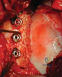 صورة توضيحية لـ ترميم التجويف الحقاني للكتف بترقيع عظمي ذاتي: حل جذري لعدم استقرار الكتف المتكرر في صنعاء