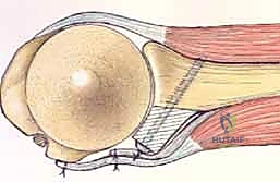 صورة توضيحية لـ ترميم التجويف الحقاني للكتف بترقيع عظمي ذاتي: حل جذري لعدم استقرار الكتف المتكرر في صنعاء