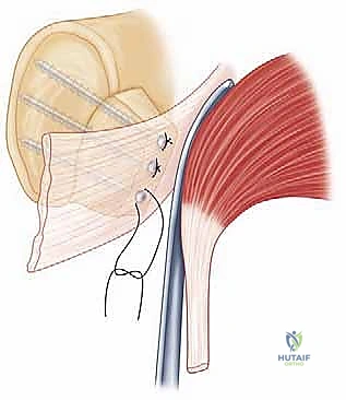 صورة توضيحية لـ ترميم التجويف الحقاني للكتف بترقيع عظمي ذاتي: حل جذري لعدم استقرار الكتف المتكرر في صنعاء