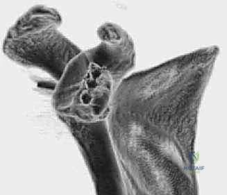 صورة توضيحية لـ ترميم التجويف الحقاني للكتف بترقيع عظمي ذاتي: حل جذري لعدم استقرار الكتف المتكرر في صنعاء