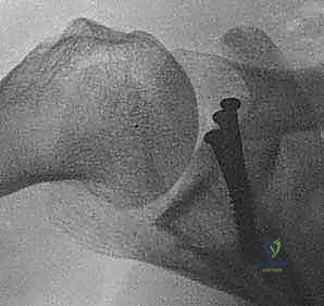 تحضير عنق التجويف الحقاني