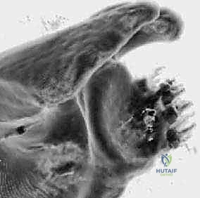 Glenoid Augmentation with Autologous Iliac Crest Bone Graft: A Masterclass in Anterior Shoulder Instability Management