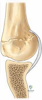 تمارين التأهيل المتقدمة لكتف الرامي