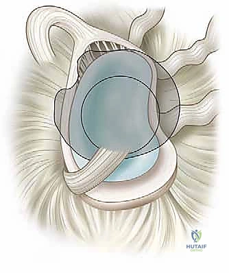 تمزق الشفا العلوي SLAP في كتف الرياضي