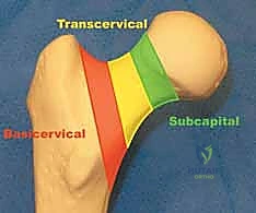 تصنيف باولز يوضح زوايا خط الكسر