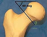 تصوير الأوعية الدموية المغذية لرأس الفخذ