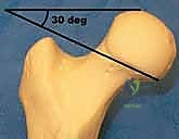 Illustration of sliding hip screw - Dr. Mohammed Hutaif