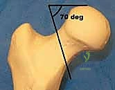تأثير الكسر على الشرايين الشبكية