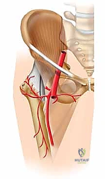 وضعية الساق المميزة بعد الكسر الدوران الخارجي والقصر