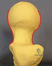 هشاشة العظام لدى كبار السن وتأثيرها