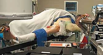 توزيع المسامير في شكل مثلث مقلوب