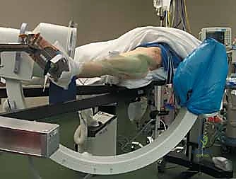 شكل المسامير المجوفة الطبية