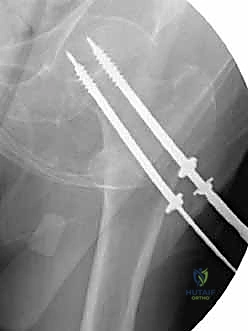 صورة أشعة سينية توضح كسر عنق الفخذ