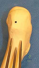 صورة توضيحية لـ كسر عنق الفخذ: العلاج الحديث بالمسامير المجوفة عبر الجلد مع الأستاذ الدكتور محمد هطيف في صنعاء