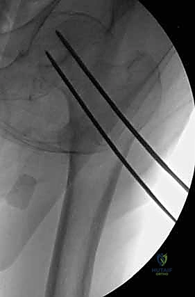 تصوير شعاعي يوضح تصنيف جاردن للكسور