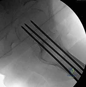 تصوير بالرنين المغناطيسي لكسر خفي