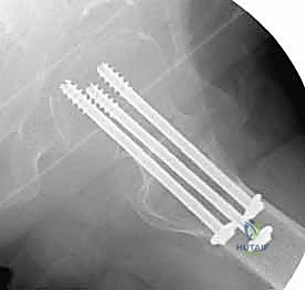 صورة مقطعية CT لكسر معقد في عنق الفخذ