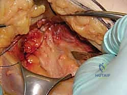 صورة توضيحية لـ كسر عنق الفخذ: العلاج الحديث بالمسامير المجوفة عبر الجلد مع الأستاذ الدكتور محمد هطيف في صنعاء