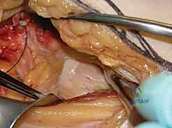 صورة توضيحية لـ كسر عنق الفخذ: العلاج الحديث بالمسامير المجوفة عبر الجلد مع الأستاذ الدكتور محمد هطيف في صنعاء