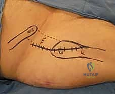 المريض على طاولة الشد العظمي