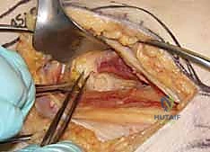 صورة طبية: كسر عنق الفخذ: العلاج الحديث بالمسامير المجوفة عبر الجلد مع الأستاذ الدكتور محمد هطيف في صنعاء