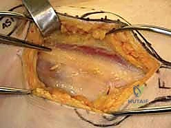 كسر عنق الفخذ: العلاج الحديث بالمسامير المجوفة عبر الجلد مع الأستاذ الدكتور محمد هطيف في صنعاء